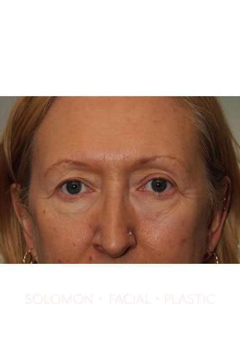 Blepharoplasty Before After Photos