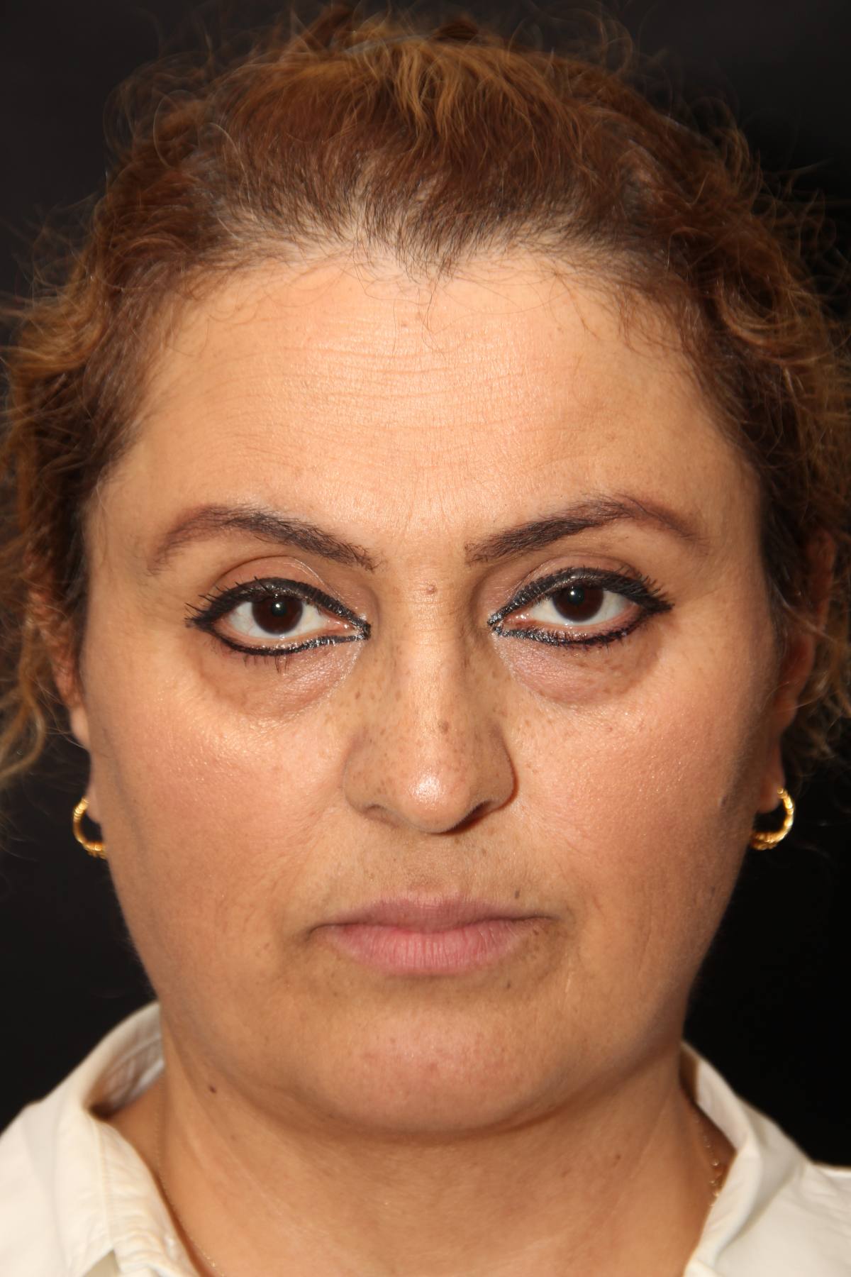 Blepharoplasty Before After Photos