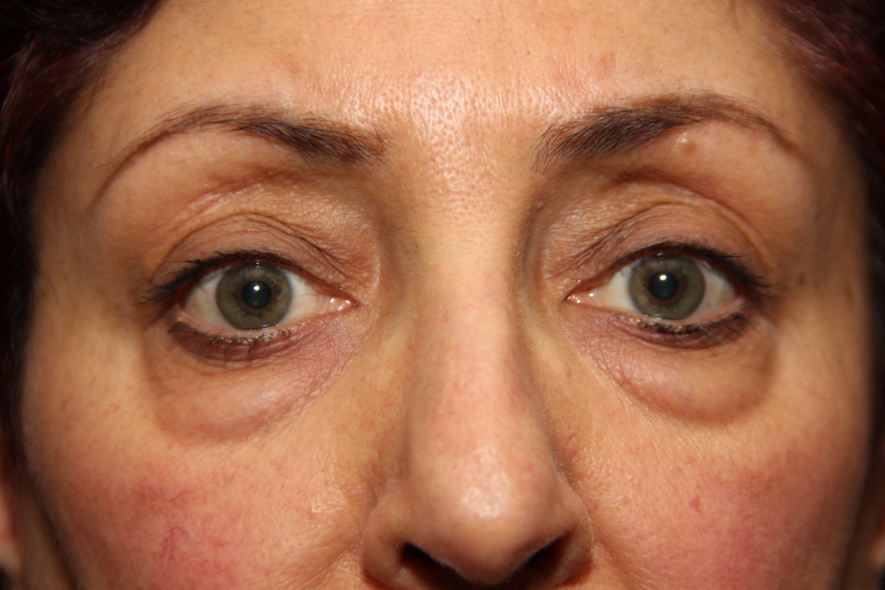 Blepharoplasty Before After Photos