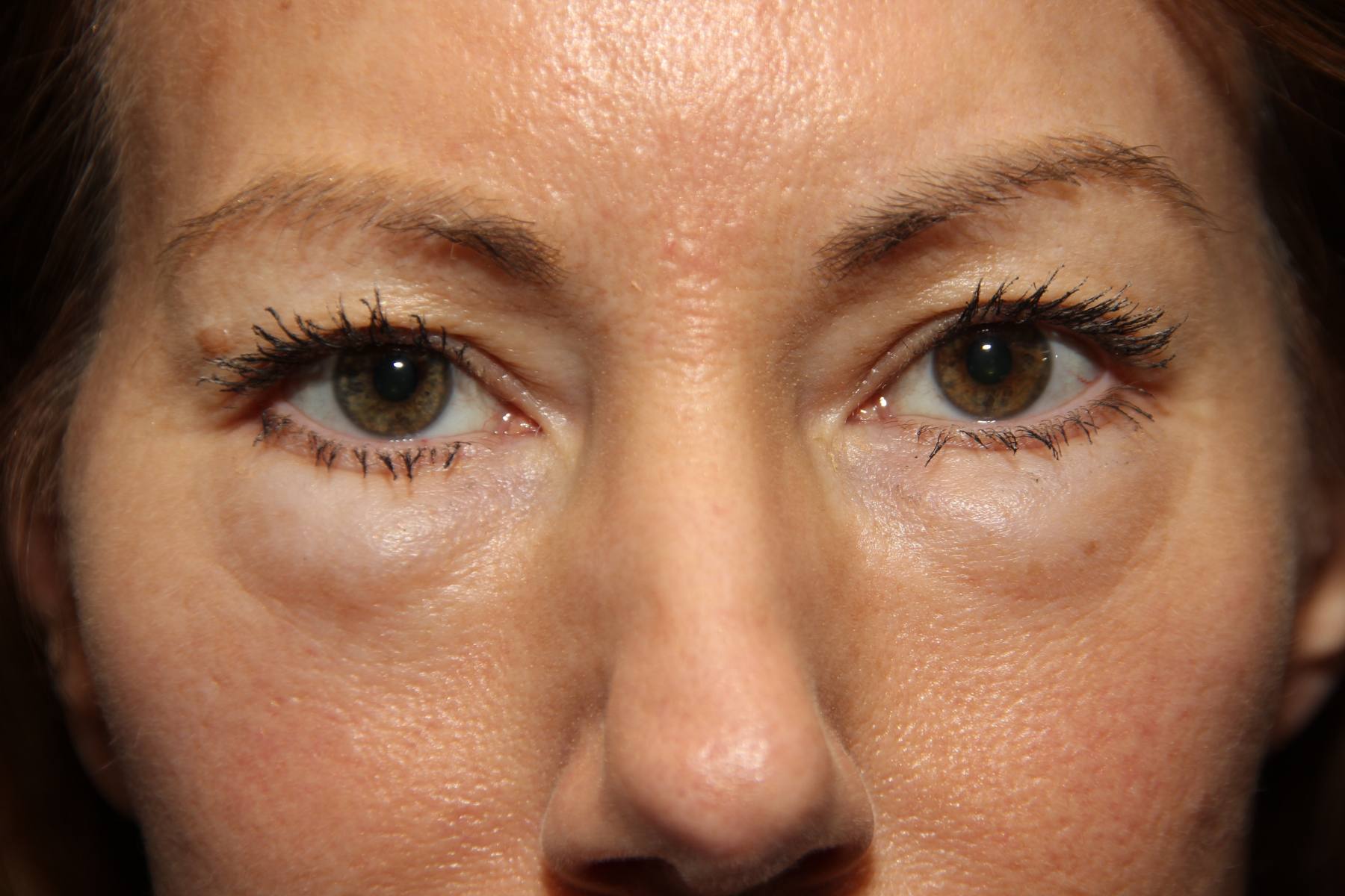 Blepharoplasty Before and After Photos