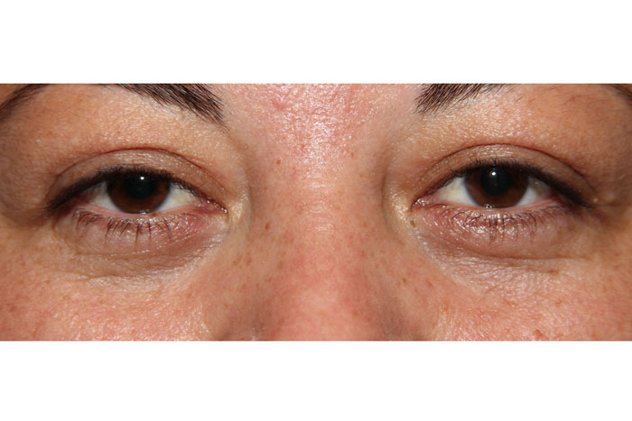 Blepharoplasty Before After Photos