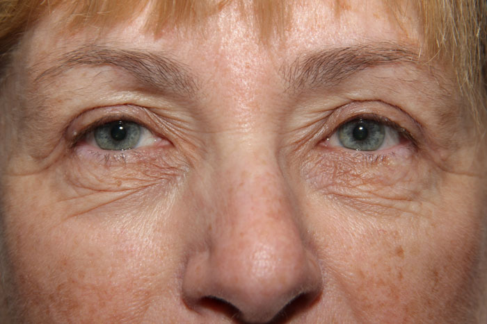 Blepharoplasty Before After Photos