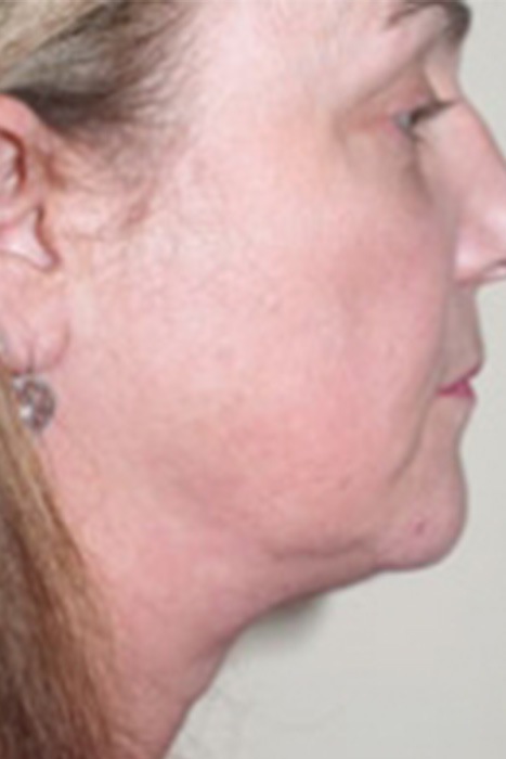 Facelift Before After Photos