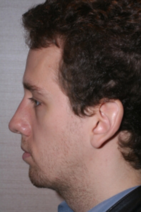 Facial Implant Before After Photos