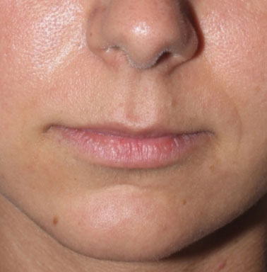 Lip Lift Before After Photos