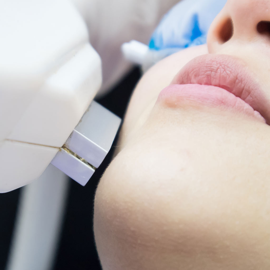 Micro Laser Peel Micro Laser Peel