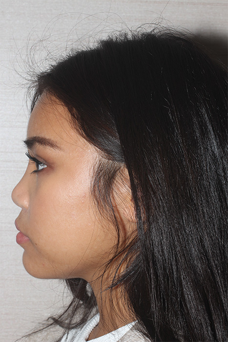 Non Caucasian Rhinoplasty Toronto Before After Photos