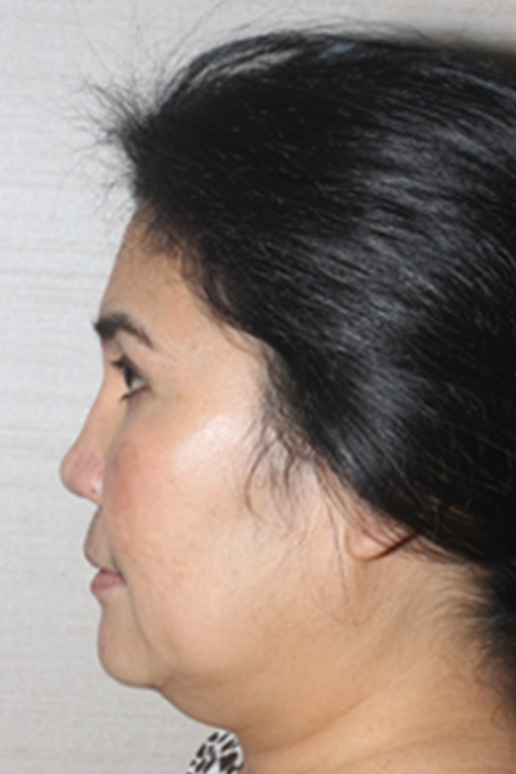 Non Caucasian Rhinoplasty Toronto Before After Photos