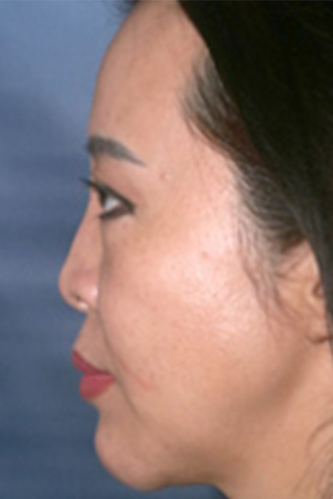 Non Caucasian Rhinoplasty Toronto Before After Photos