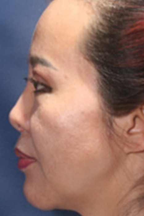 Non Caucasian Rhinoplasty Toronto Before After Photos