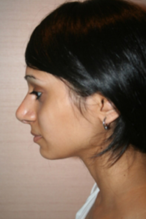 Non Caucasian Rhinoplasty Toronto Before After Photos