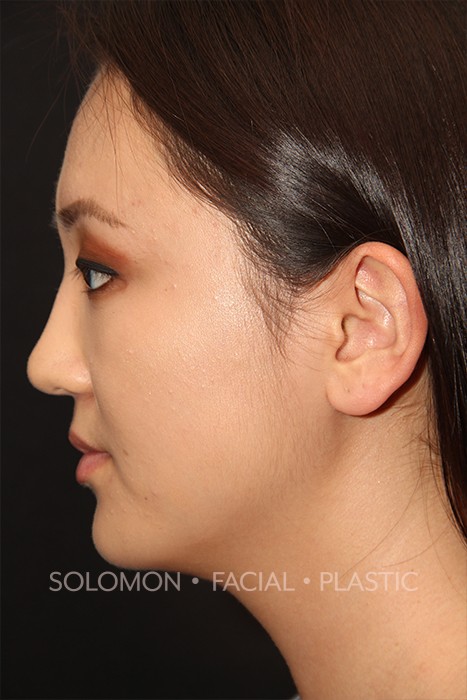 Non Caucasian Rhinoplasty Toronto Before After Photos