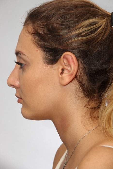 Rhinoplasty Toronto Before & After Photos