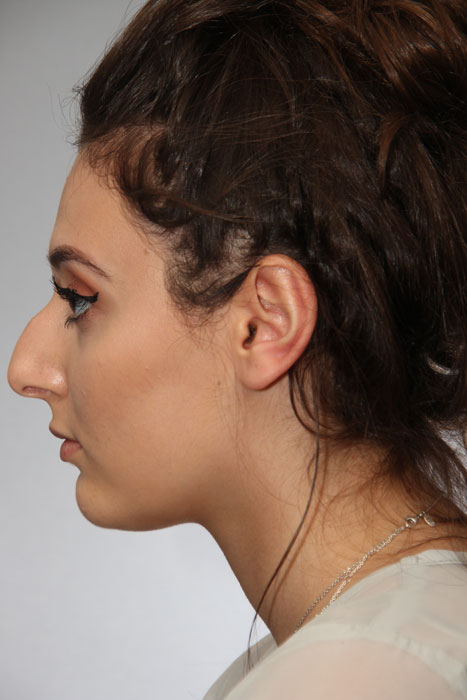 Rhinoplasty Toronto Before & After Photos