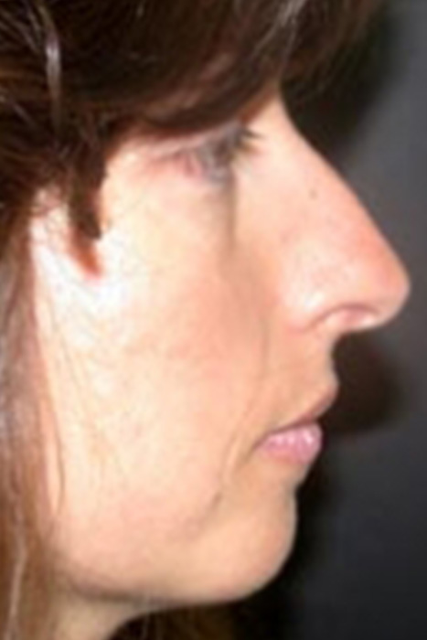 Rhinoplasty Toronto Before & After Photos