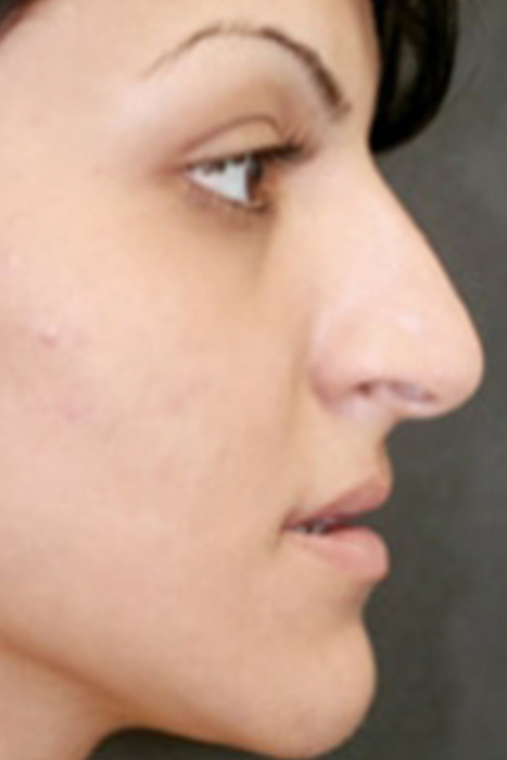 Rhinoplasty Toronto Before & After Photos