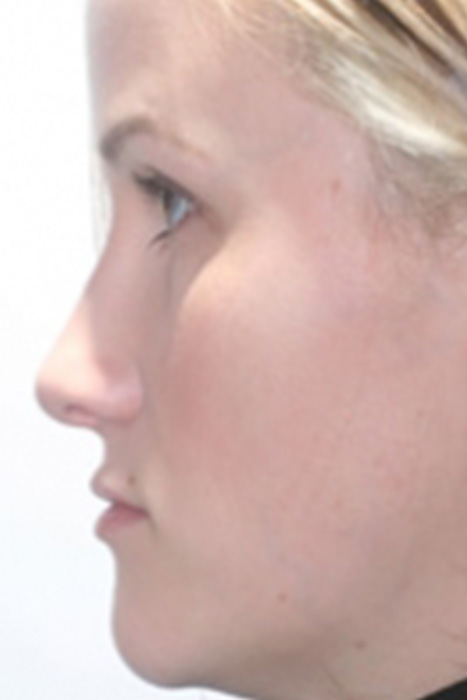 Rhinoplasty Toronto Before & After Photos