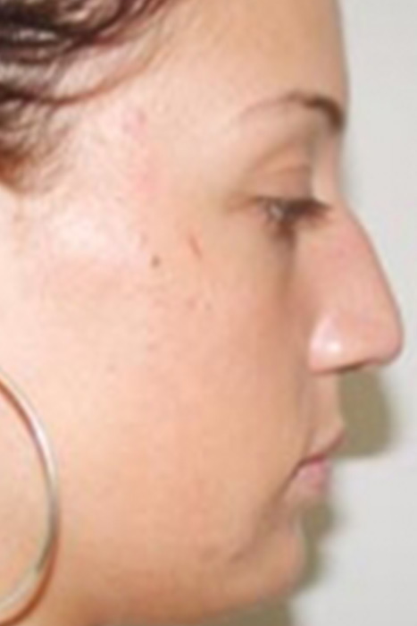 Rhinoplasty Toronto Before & After Photos