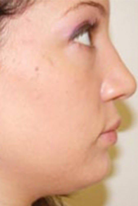 Rhinoplasty Toronto Before & After Photos