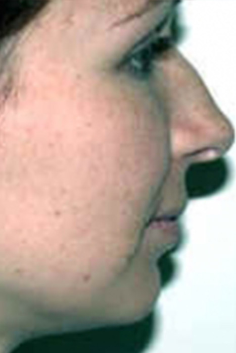 Rhinoplasty Toronto Before & After Photos