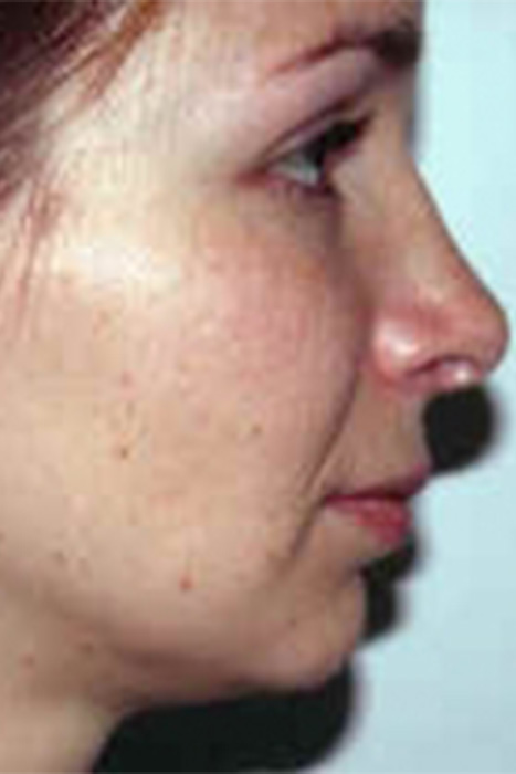 Rhinoplasty Toronto Before & After Photos