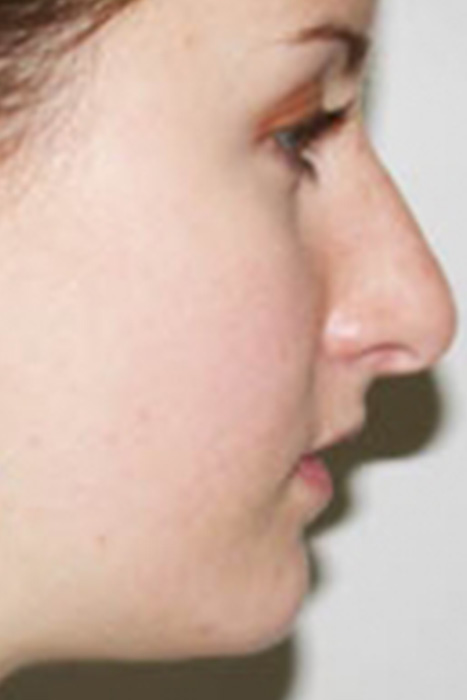 Rhinoplasty Toronto Before & After Photos