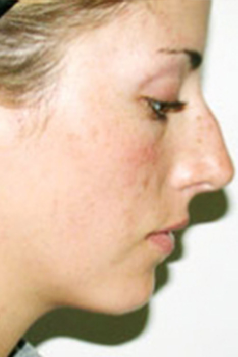 Rhinoplasty Toronto Before & After Photos