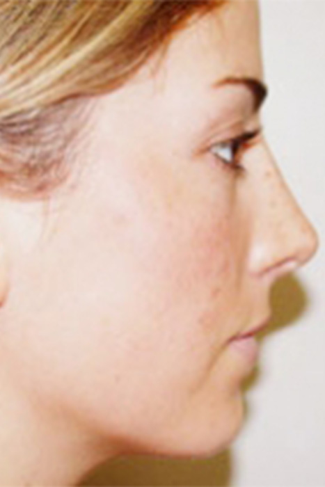 Rhinoplasty Toronto Before & After Photos