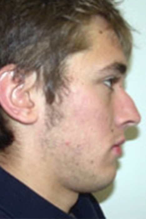 Rhinoplasty Toronto Before & After Photos