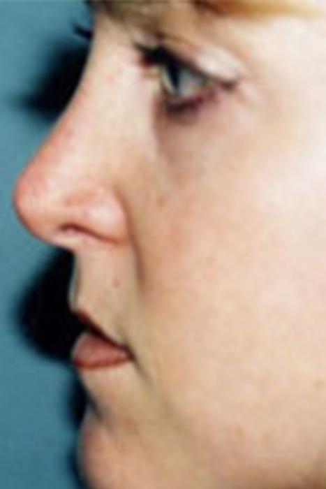 Rhinoplasty Toronto Before & After Photos