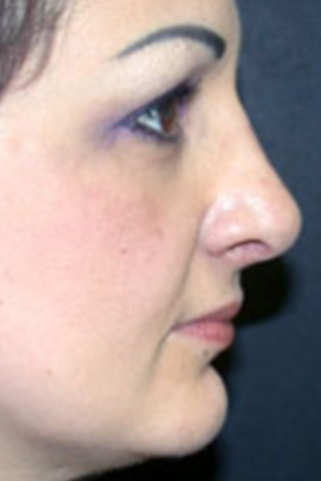 Rhinoplasty Toronto Before & After Photos