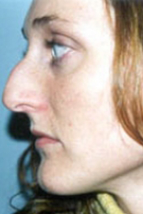 Rhinoplasty Toronto Before & After Photos