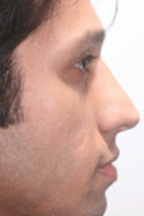 Rhinoplasty Toronto Before & After Photos