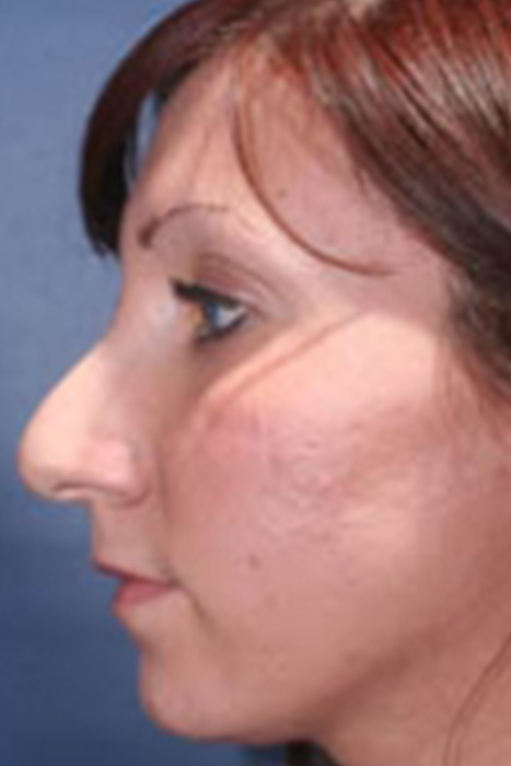 Rhinoplasty Toronto Before & After Photos