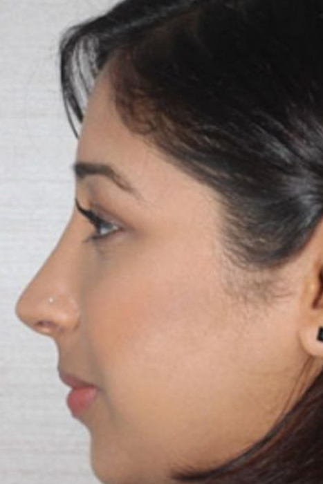 Rhinoplasty Toronto Before After Photos