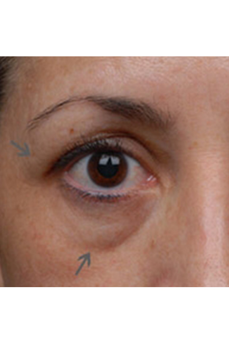 Pelleve Facial Skin Tightening Before After Photos