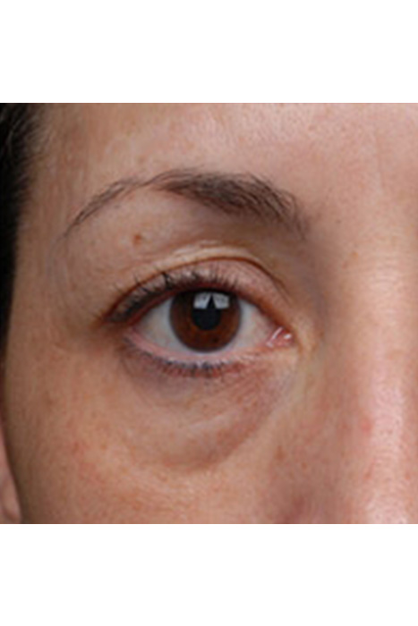 Pelleve Facial Skin Tightening Before After Photos