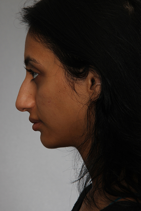 Rhinoplasty Toronto Before & After Photos