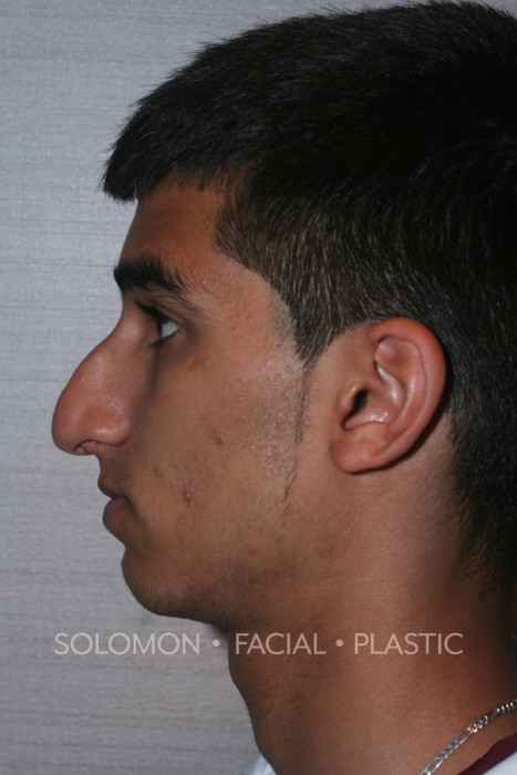 Rhinoplasty Toronto Before After Photos