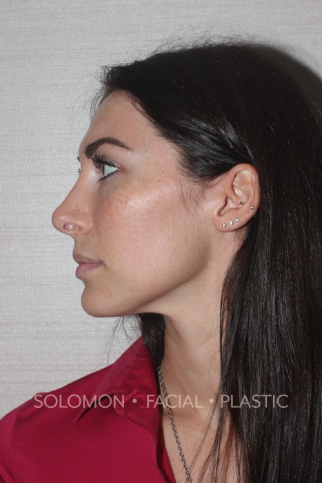 Rhinoplasty Toronto Before After Photos