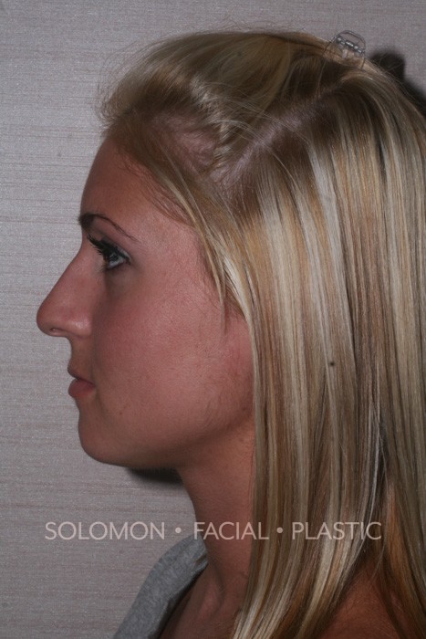 Rhinoplasty Toronto Before After Photos