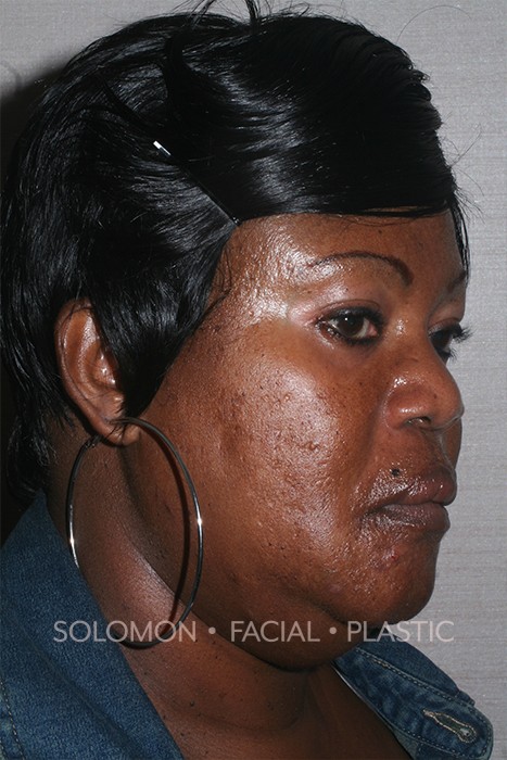 Facial Liposuction Before After Photos