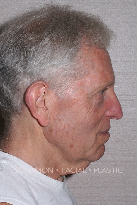 Neck Plasty Before After Photos