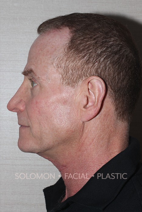 Neck plasty Before After Photos