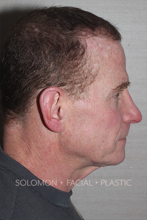Neck plasty Before After Photos