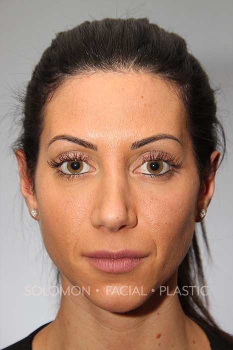 Otoplasty Before After Photos