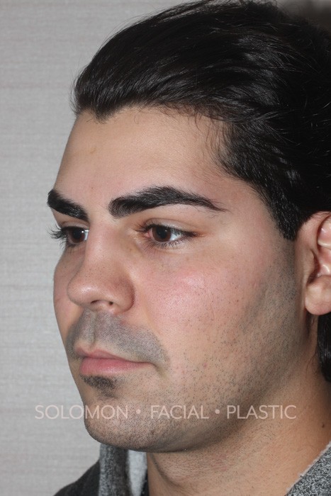 Revision Rhinoplasty Toronto Before After Photos