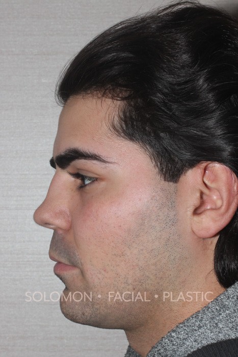 Revision Rhinoplasty Toronto Before After Photos