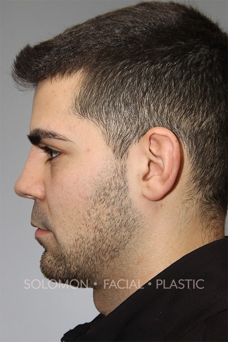 Revision Rhinoplasty Toronto Before After Photos