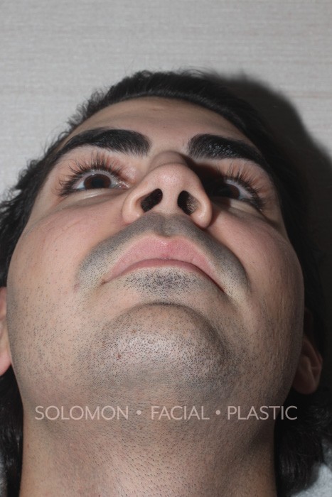 Revision Rhinoplasty Toronto Before After Photos-27